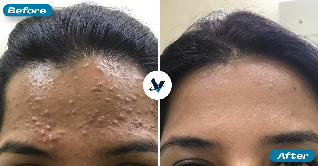 Severe forehead pimples cleared completely - Pimple Treatment Bangalore, VTIARA Clinic