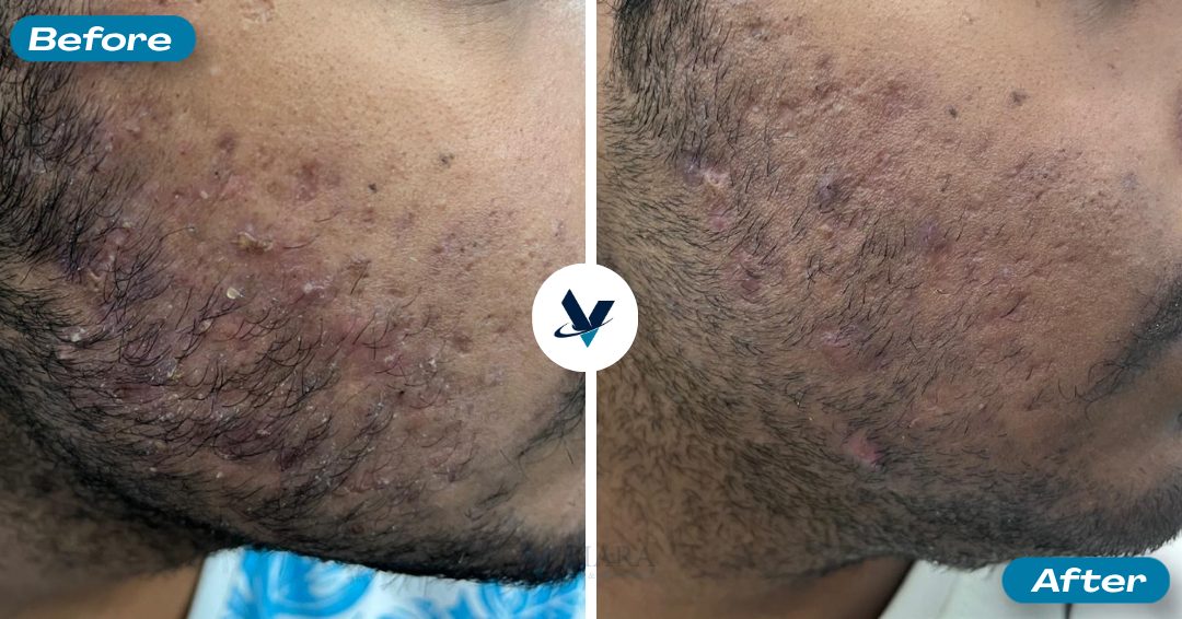Cystic jawline pimples calmed - Pimple Treatment Bangalore, VTIARA Clinic