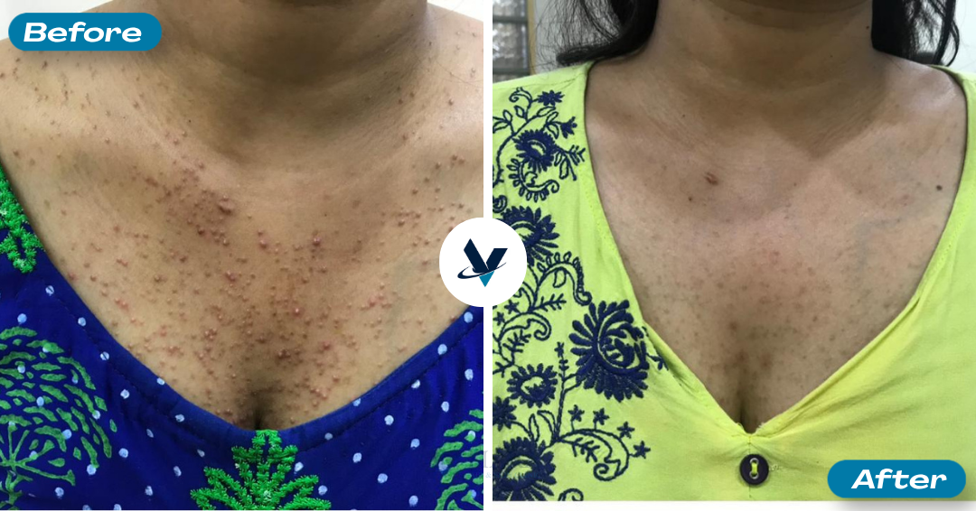 Chest pimples cleared completely - Pimple Treatment Bangalore, VTIARA Clinic