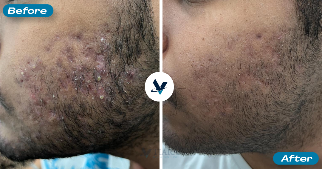 Back pimple breakouts reduced - Pimple Treatment Bangalore, VTIARA Clinic
